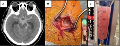 Chylomicronemia through a burr hole: A case report